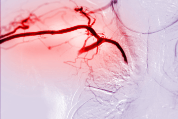 angioplasty treatment